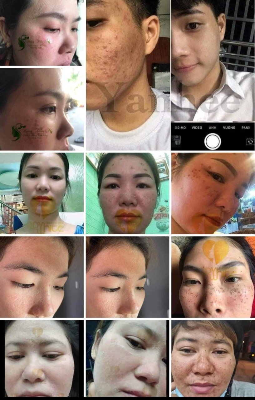 Combo 2 Chai Tái Tạo Da Phương Anh Yody White