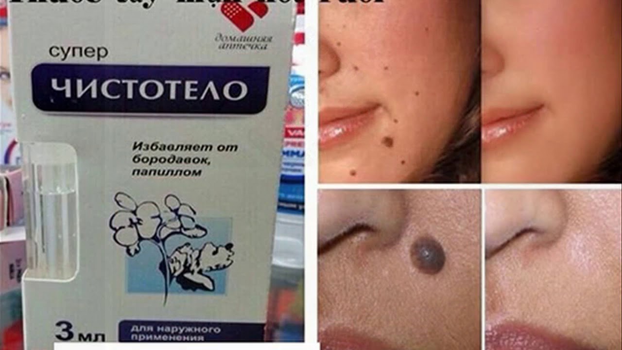 Gel chấm tàn nhang, nốt ruồi