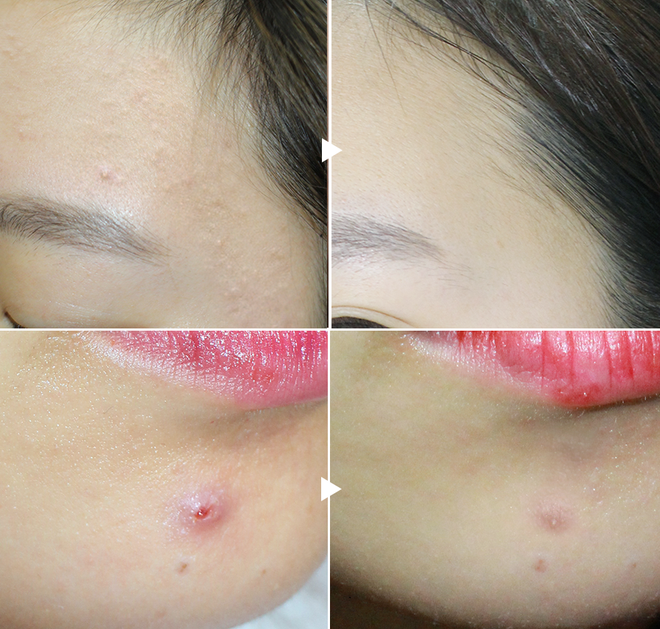 Kem Giảm Sẹo Gentacin Nhật Tuýp 10g