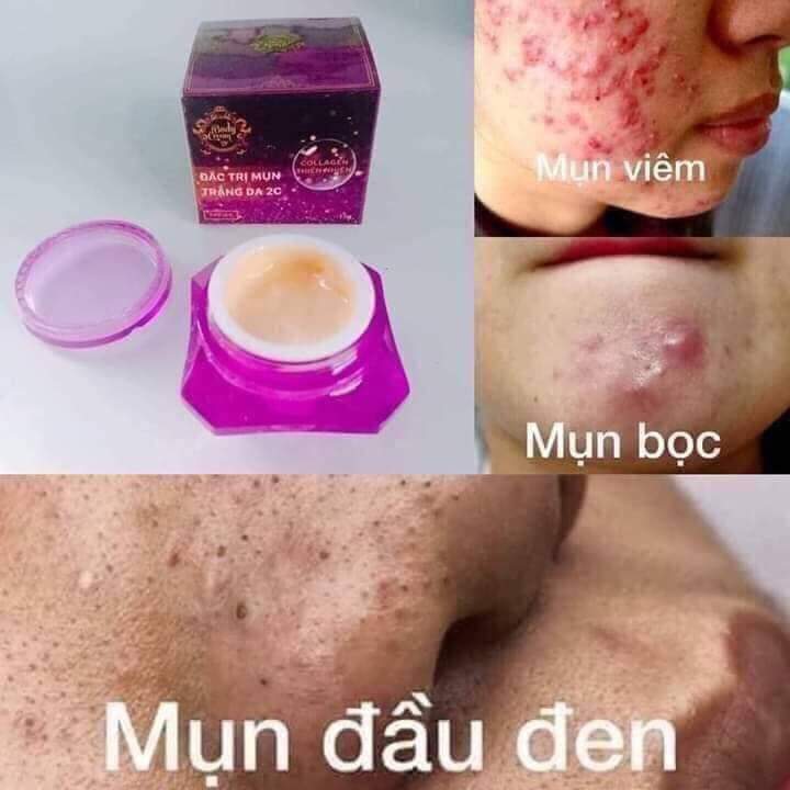 Kem mụn trắng da 2c chính hãng