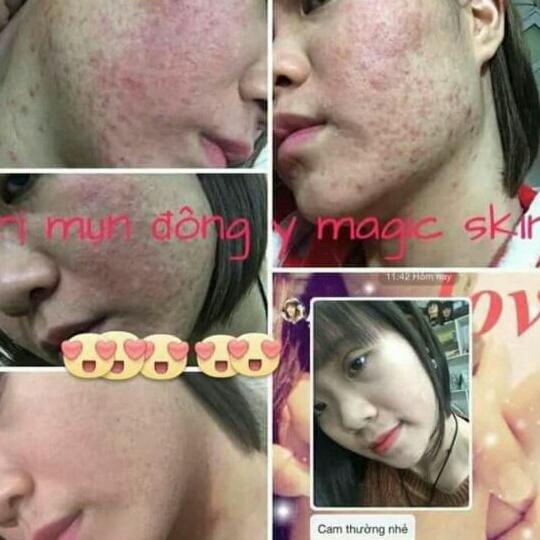 TINH CHÂT NGỪA MỤN ĐÔNG Y MAGIC SKIN