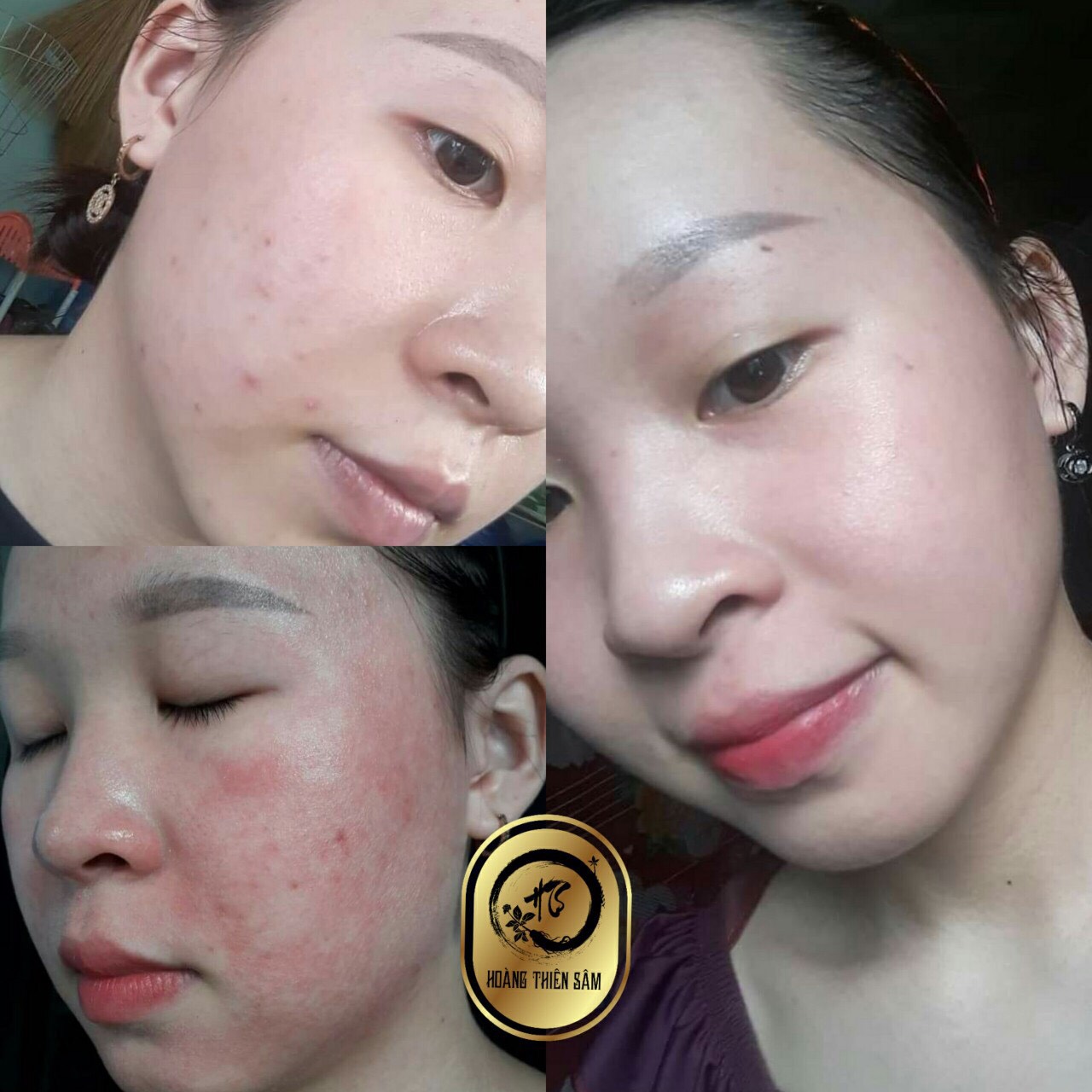 TIHH CHẤT TÁI TẠO DA HOÀNG THIÊN SÂM VIP