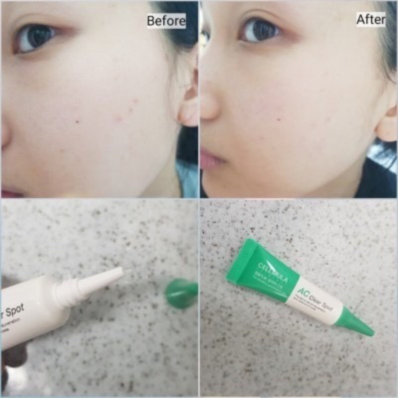 Kem chấm mụn AC CLEAR SPOT gel