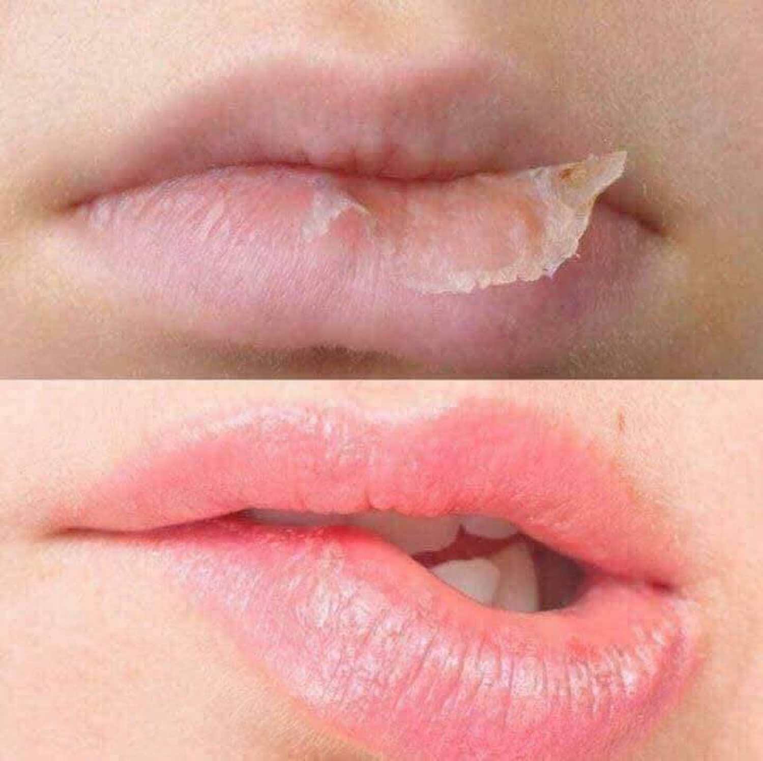 Kem nẻ Vaseline 100g Viện Bỏng - KNE