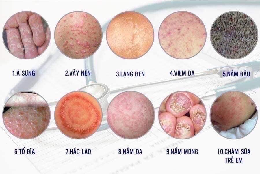 kem điều tri dứt điểm ngứa, viêm da