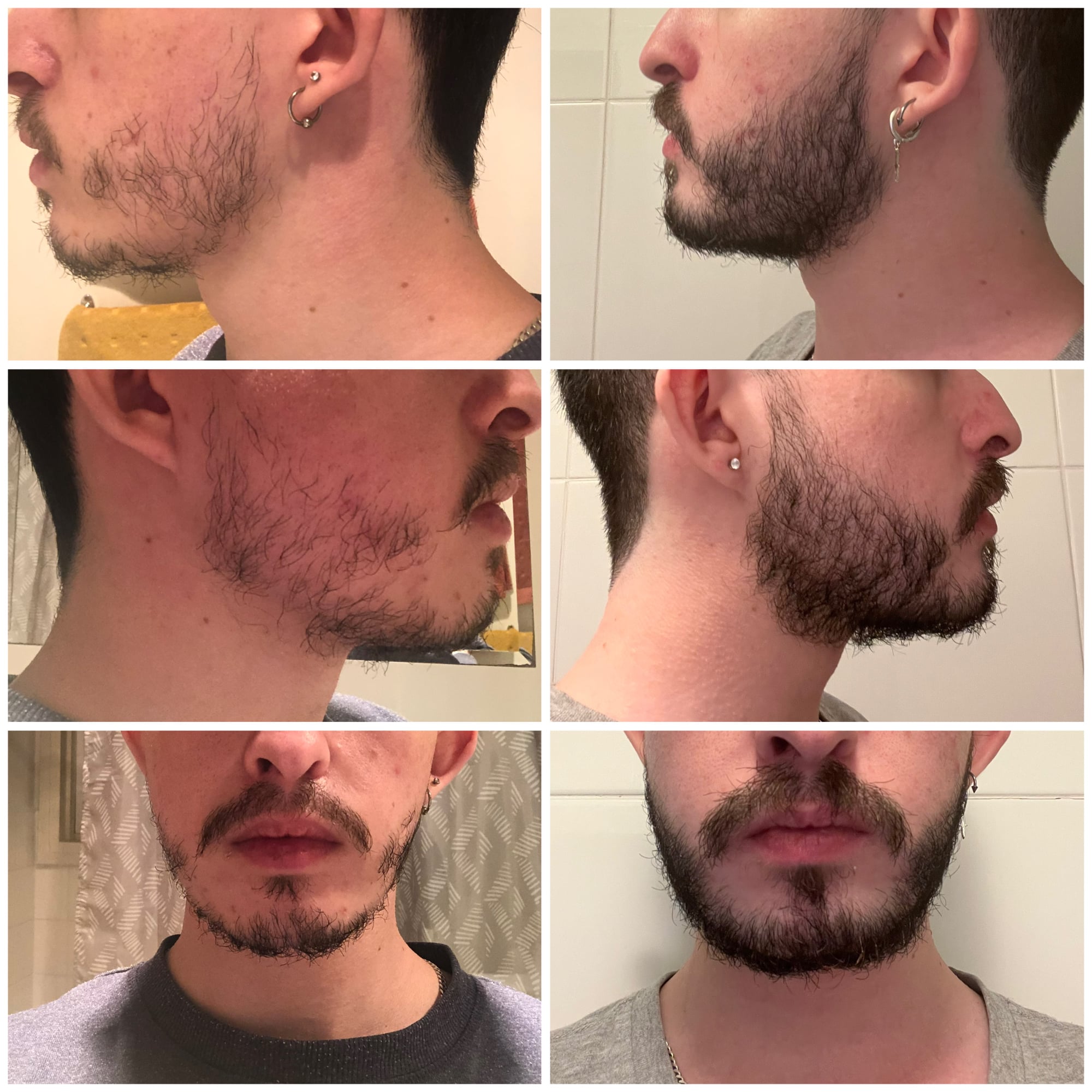 [HCM]Minoxidil 5% Bọt Mọc Râu Nhanh + Biotin 10000mcg