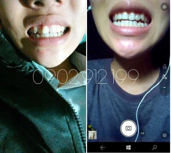 DỤNG CỤ NIỀNG RĂNG │Thế Hệ Mới 2019 - Bộ 3 hàm A1 + A2 + A3