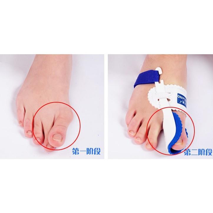 dụng cụ nẹp định hình ngón chân