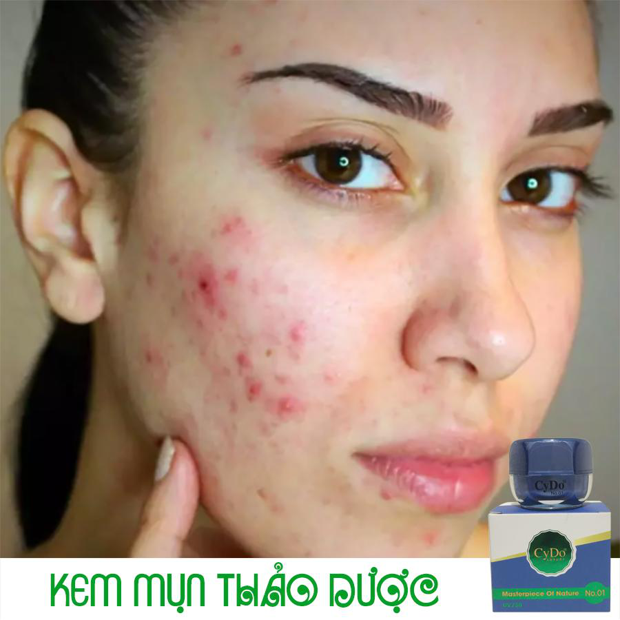 Kem mụn thảo dược CyDo 12g