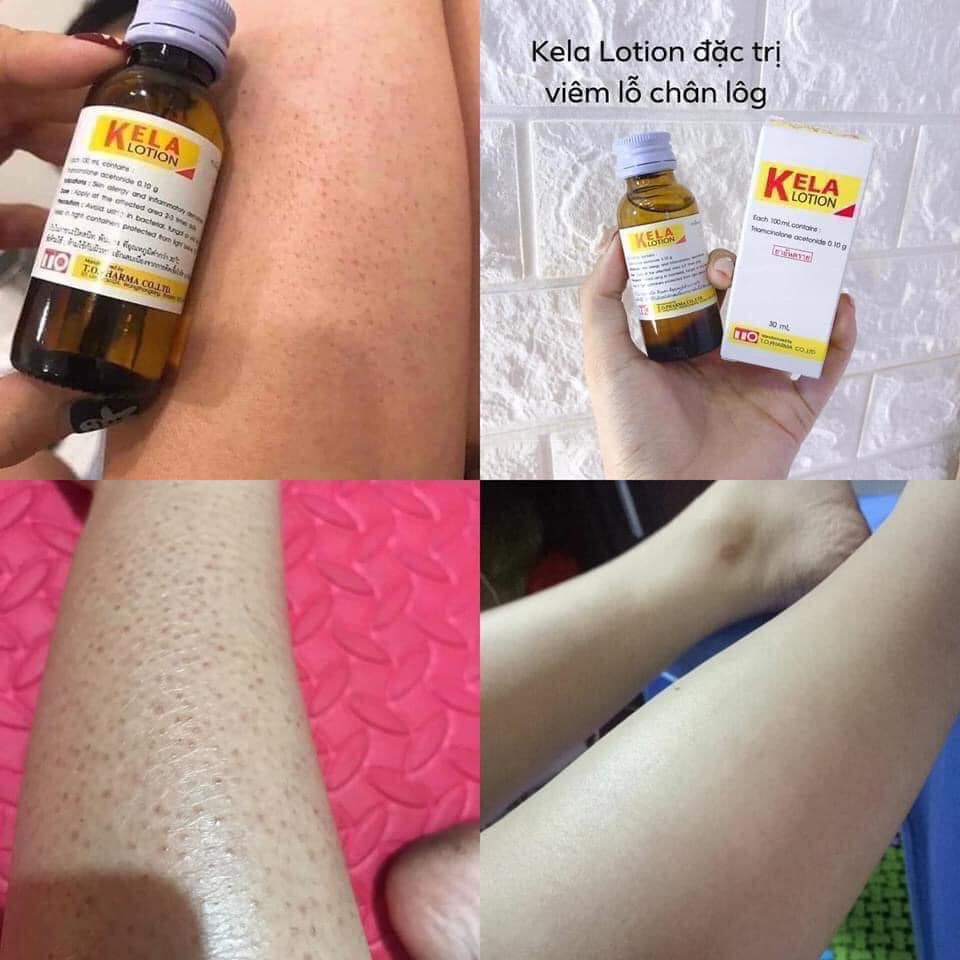 KELA LOTION THÁI LAN - xóa viêm lỗ chân lông