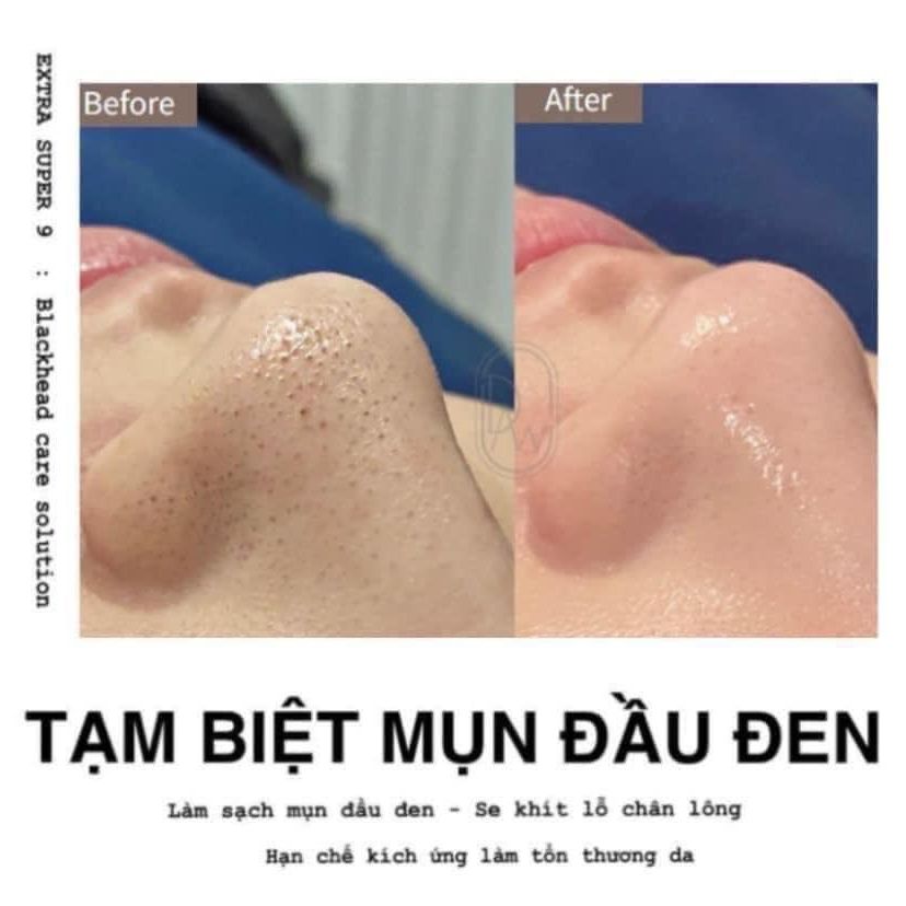 (CHIẾT 100ML) Ủ MỤN ĐẦU ĐEN Medipeel Extra Super 9 100ml [Chính Hãng] [Mẫu mới]
