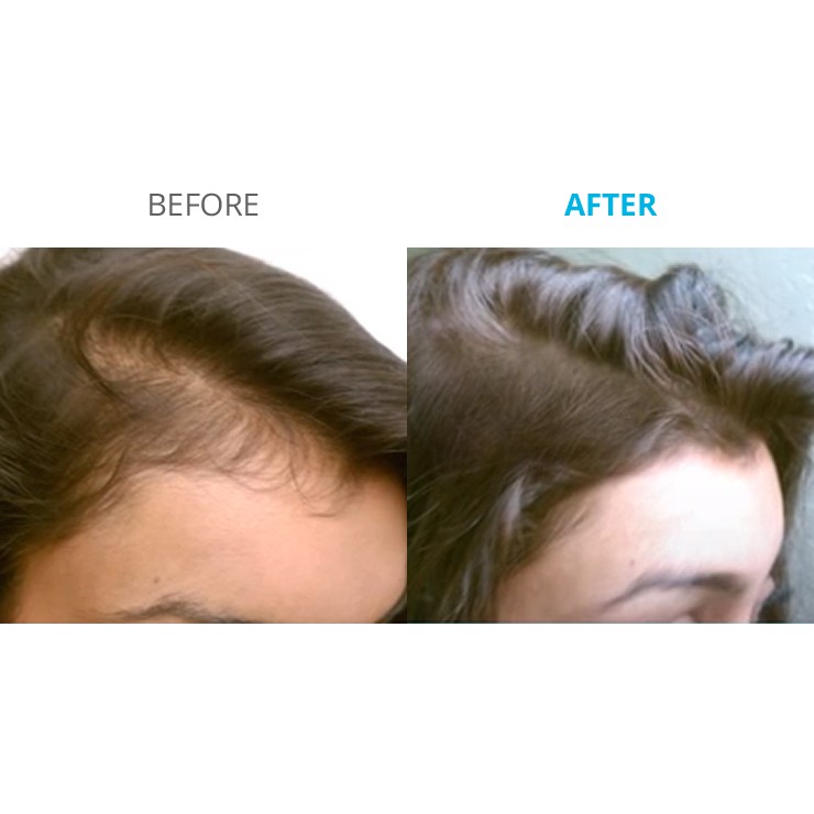 Dung Dịch Mọc Tóc - Mọc Lông Vùng Kín Nữ Minoxidil Basic Care 5% Dạng Bọt (Hỗ Trợ Che Tên Sản Phẩm)