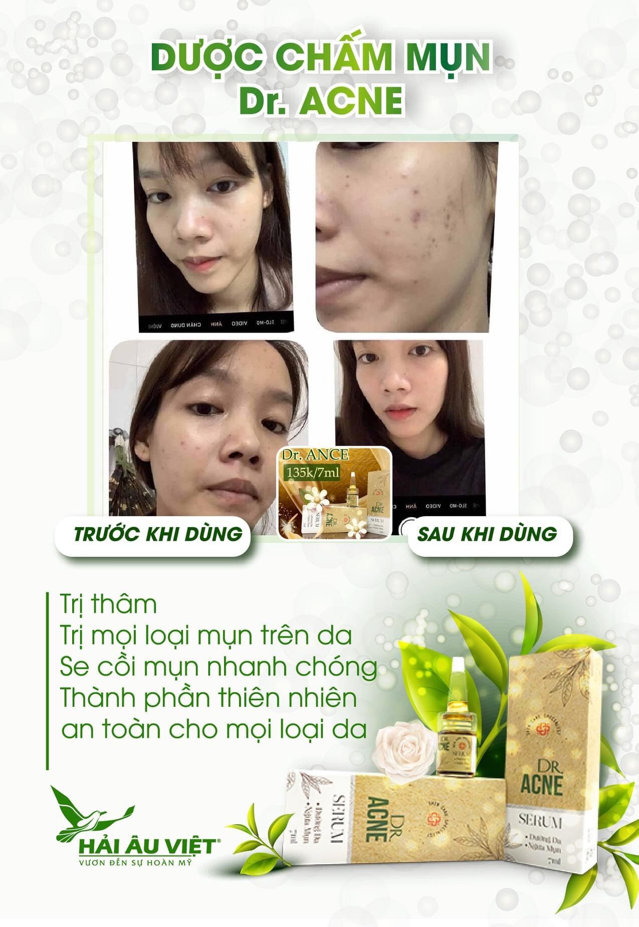 [Combo Ngừa Mụn] Sữa Rửa Mặt Napoli+Dược Chấm Mụn