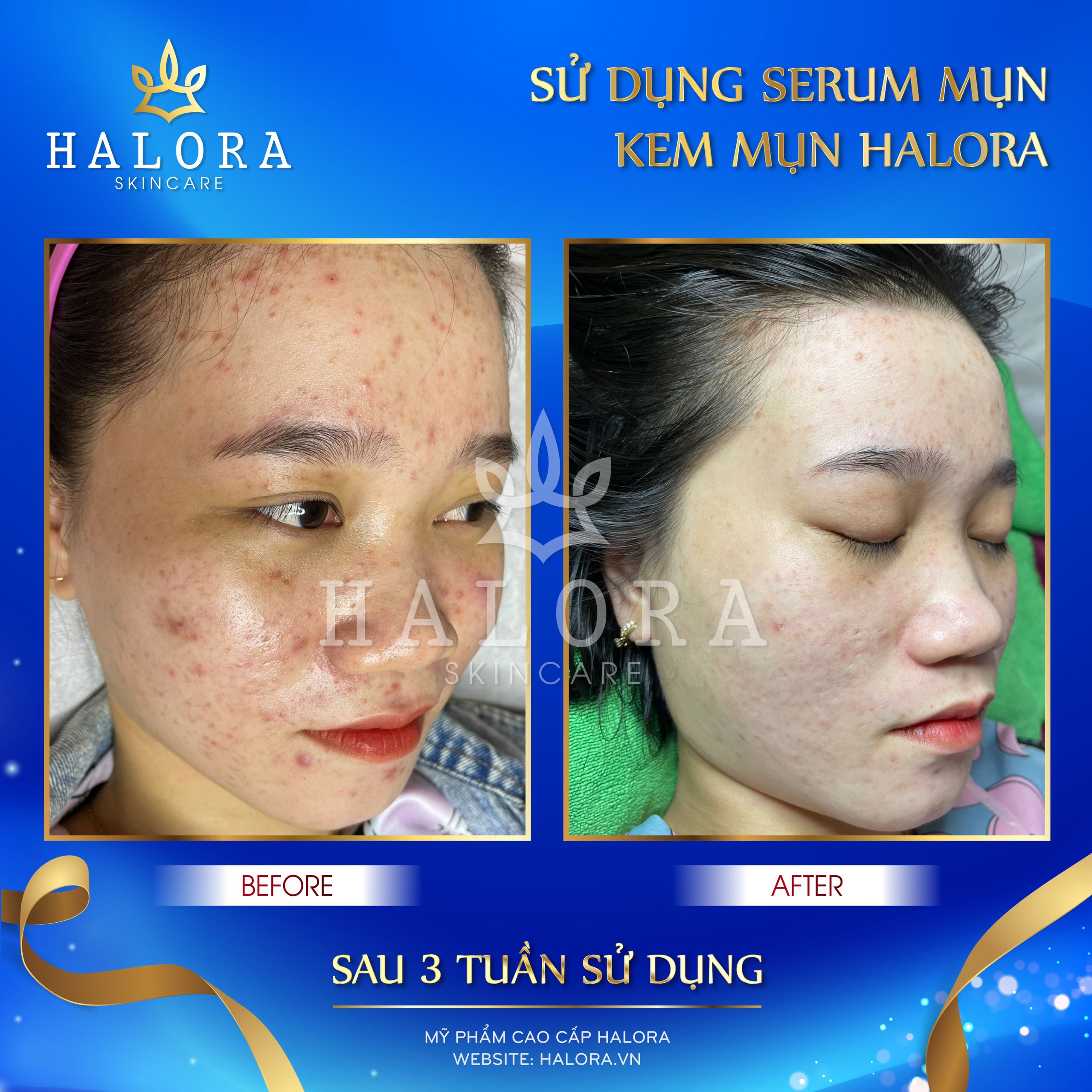 [HCM]Serum Mụn Halora