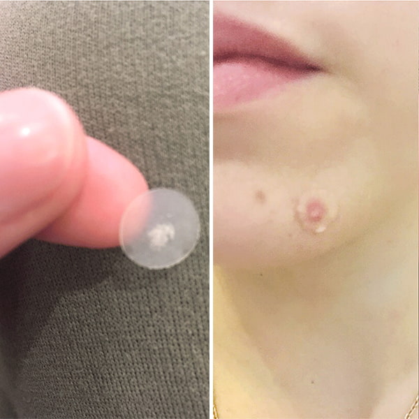 Miếng Dán Mụn Zero Spot Patch Nhật Bản 54 Miếng