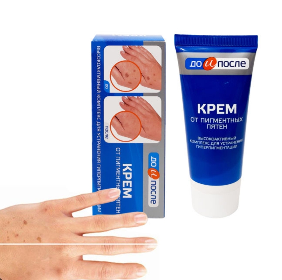 Kem giảm đồi mồi tay Nga