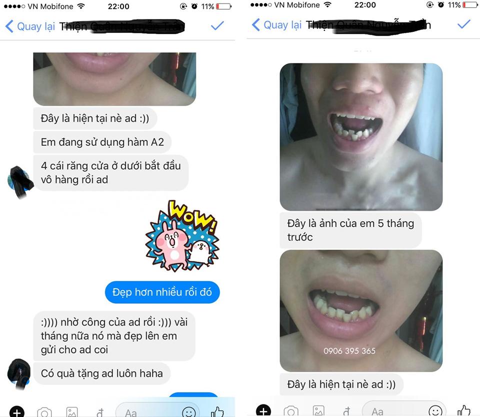 [HCM]DỤNG CỤ NIỀNG RĂNG [[ Dùng cho người lớn ]]( A1 + A2 +A3)