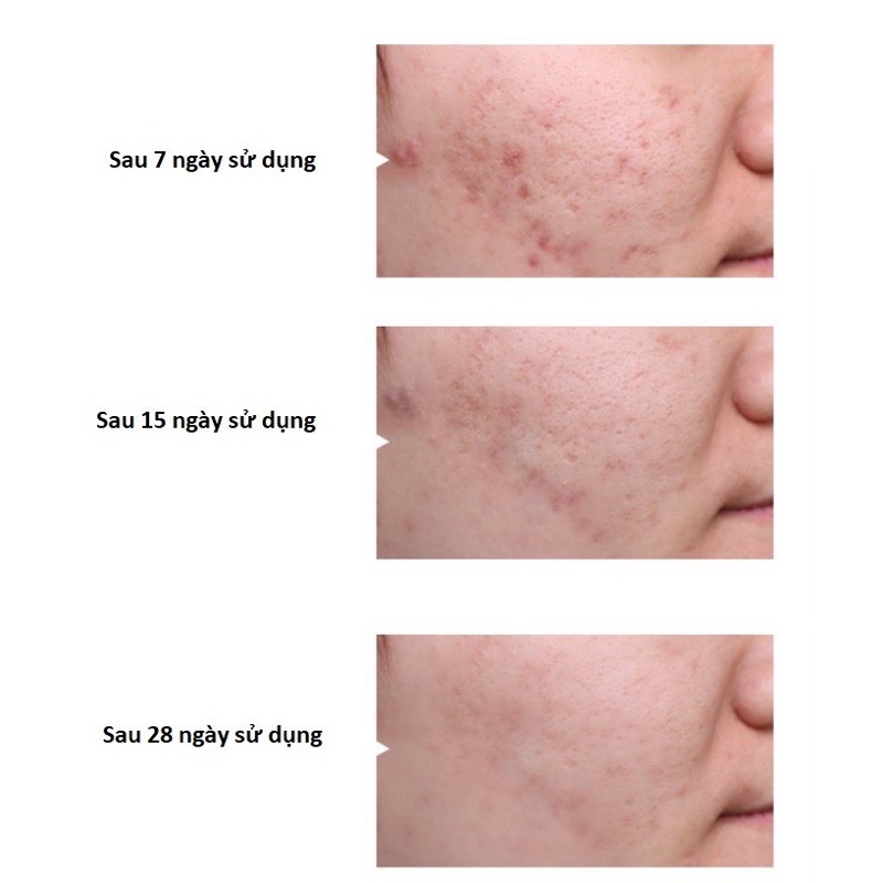 Serum Giảm Mụn Mờ Thâm Dưỡng Trắng Da