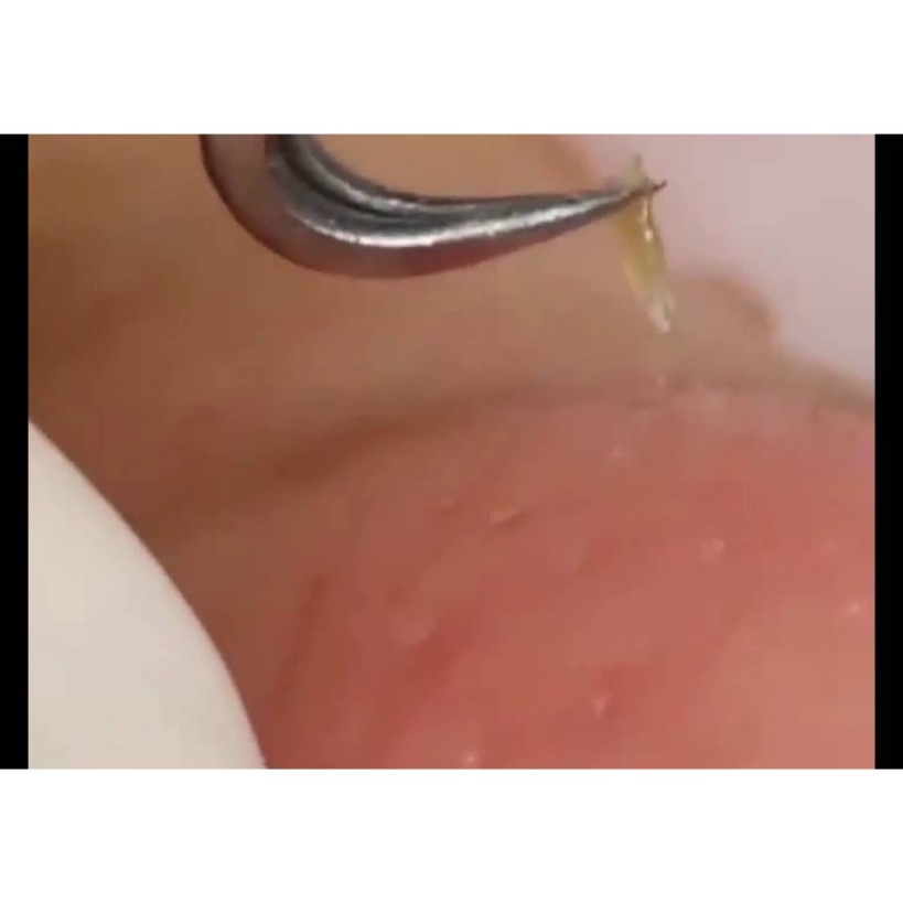 Combo 2 Nhíp gắp mụn chuyên dụng