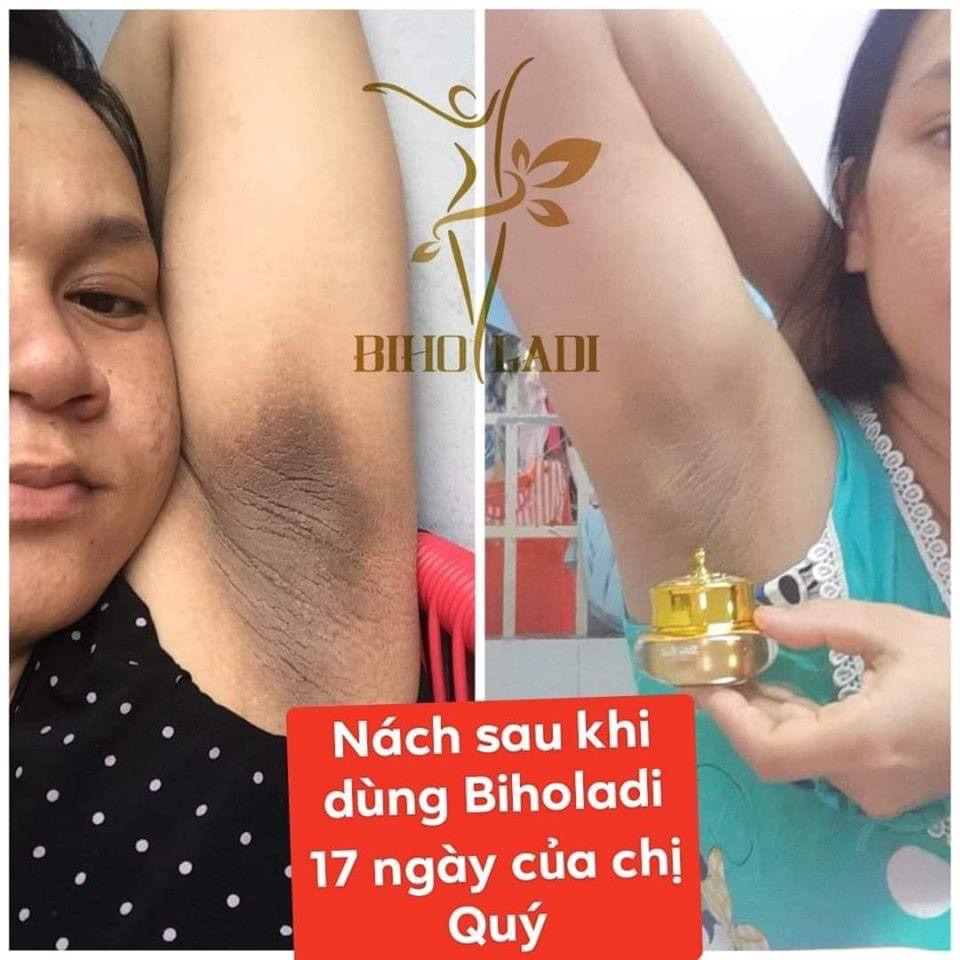 Siêu Dưỡng Thâm 5s Biho Ladi