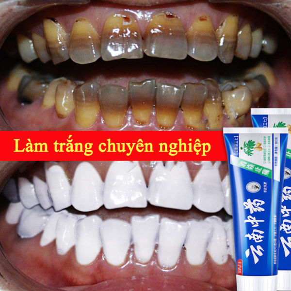 Kem đánh răng y học Cổ truyền Trung Quốc Vân Nam Tinh chất thảo dược chống nhạy cảm [180ml], vệ sinh răng miệng làm trắng chuyên nghiệp ,để loại bỏ vết bẩn mảng bám răng