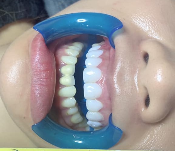 thuốc tẩy trắng răng philipin (bật tông cực trắng. không gây ê buốt)
