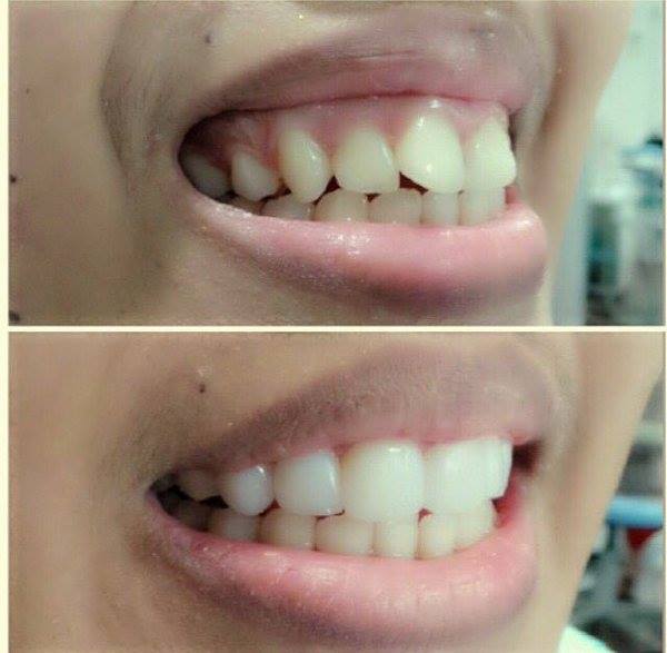 [HCM]DỤNG CỤ NIỀNG RĂNG │Lẻ hàm A2
