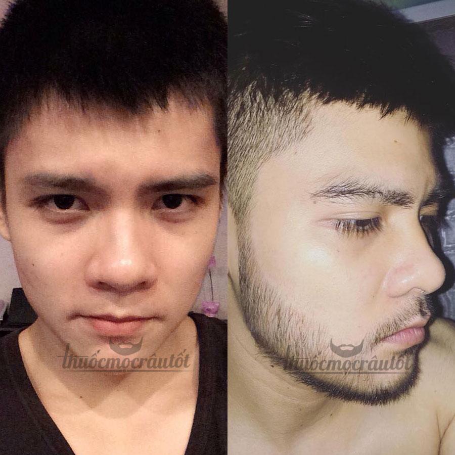 [HCM]Minoxidil 5% mọc Râu Tóc Mỹ hãng Kirkland tặng bột LCLT