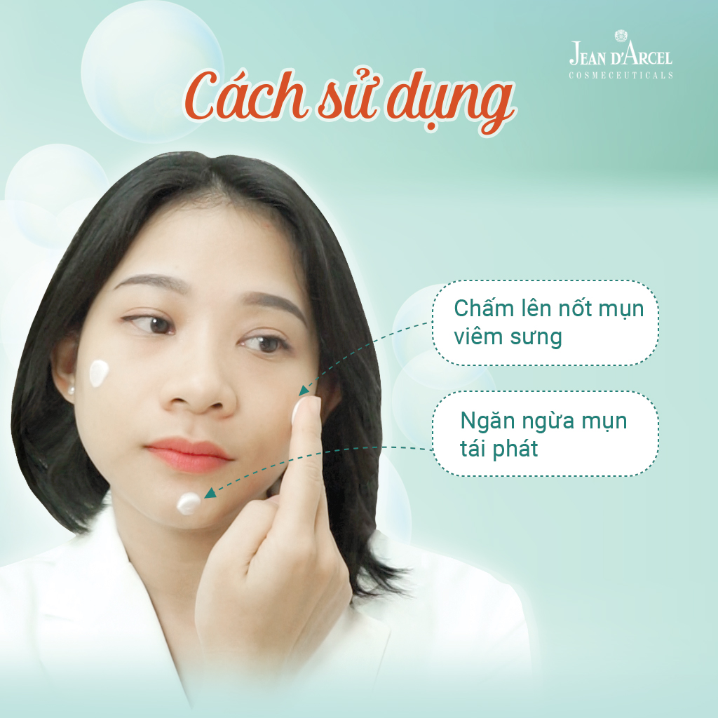 Kem giảm mụn nhanh - J11 - Blemish Control