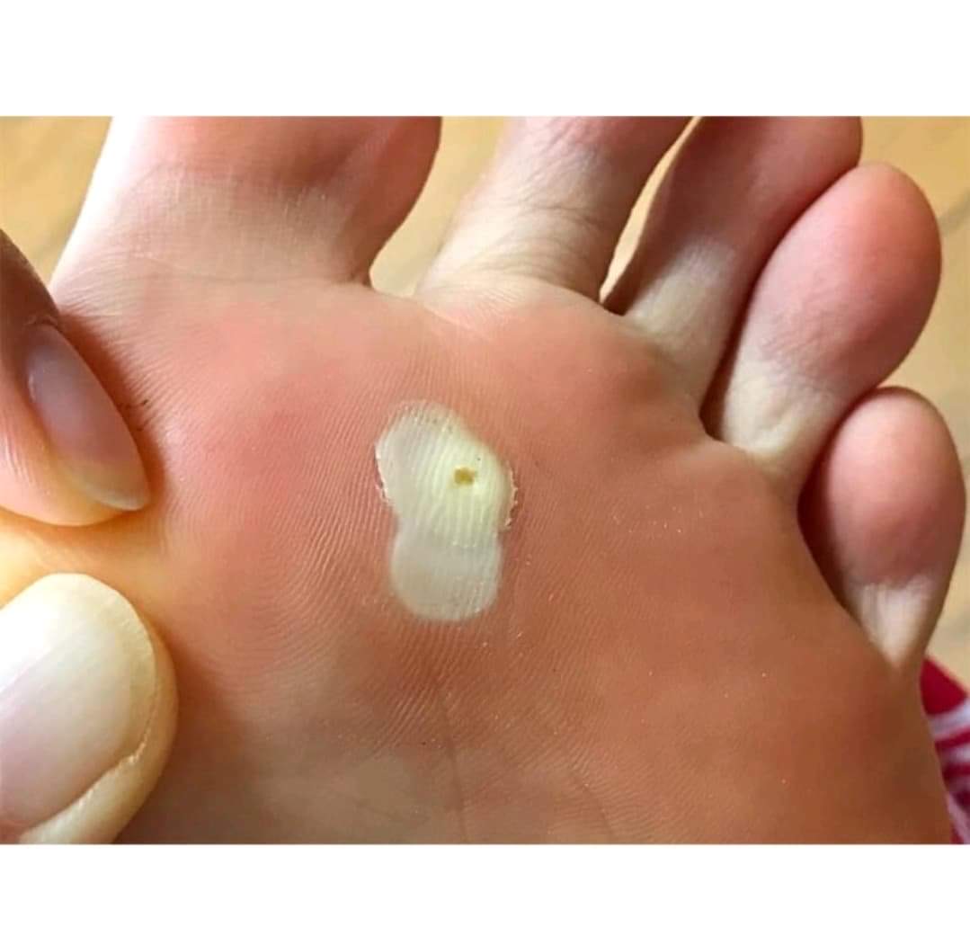[CHÍNH HÃNG] Miếng dán Ibokorori xoá mụn cơm mụn cóc mắt cá chân Nhật Bản
