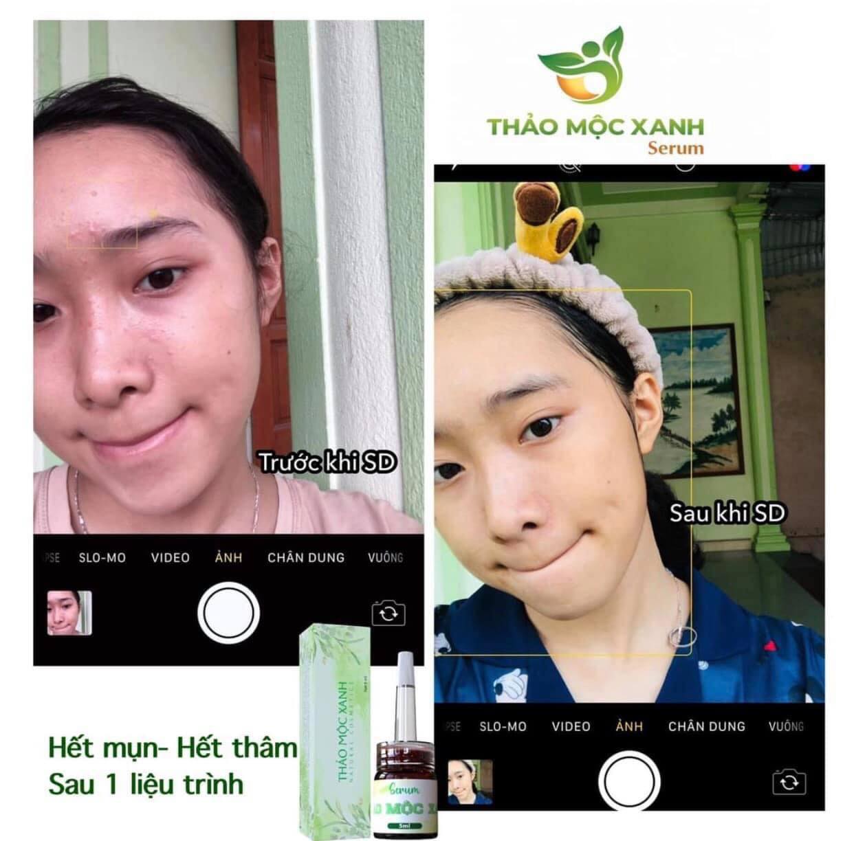 Serum Thảo Mộc Xanh Hàng Chính Hãng