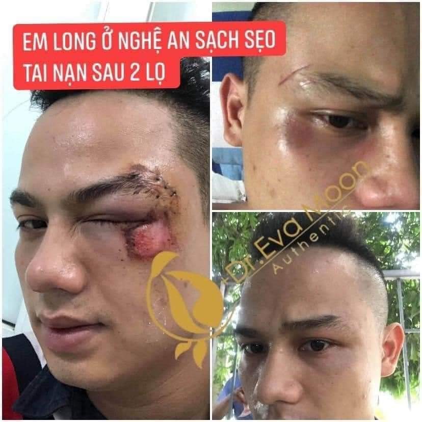 SẸO RỖ HIỆU QUẢ