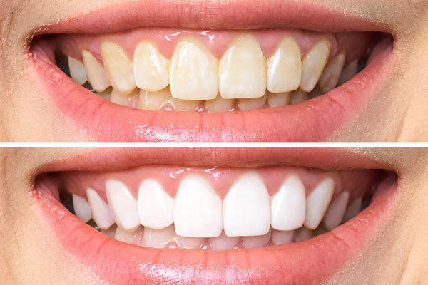 Kem Đánh Răng Tẩy Ố Vàng Răng Thái Lan Disaar  - Mẫu mới