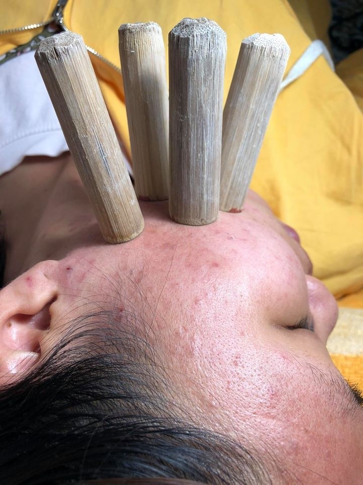 Combo 50 ống tre hút mụn