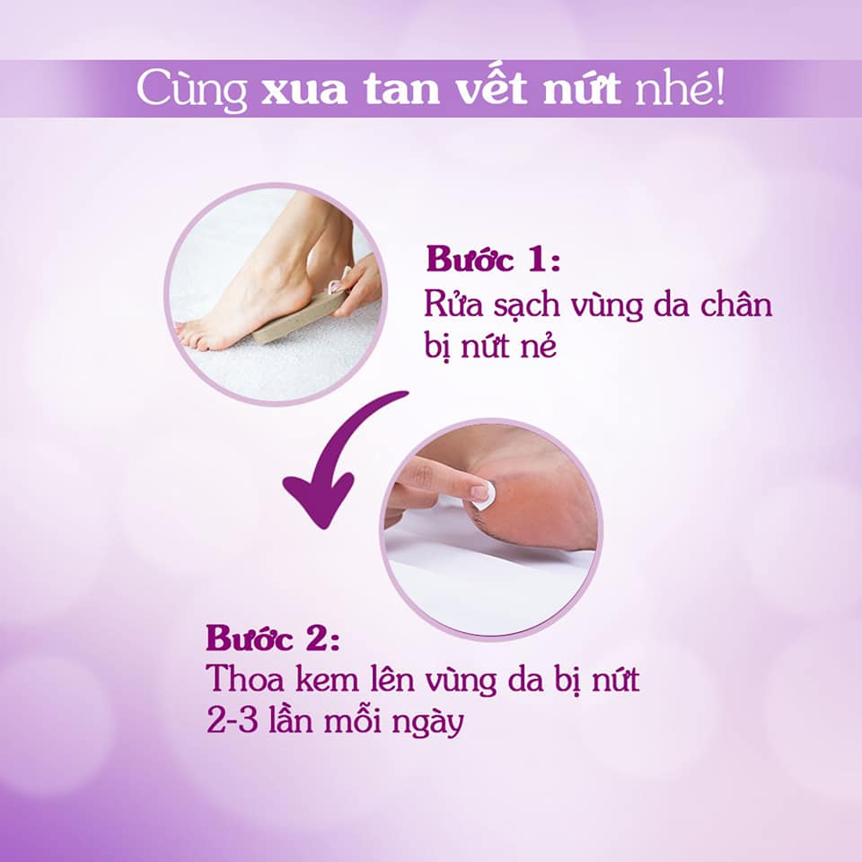 KEM THOA NỨT GÓT CHÂN ORISS 30G