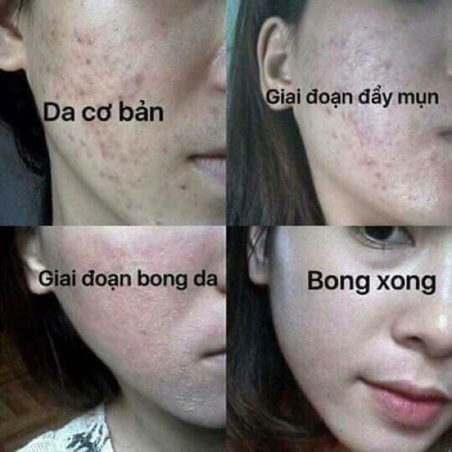 [HCM]Tái Tạo Da Hết Mụn Hết Nám Sạm Trắng Hồng