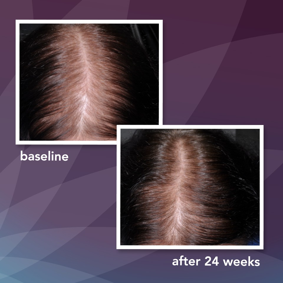 [HCM]Dung Dịch Mọc Tóc Minoxidil 5% Womens  Dạng Bọt Dành Cho Nữ Hãng Rogaine