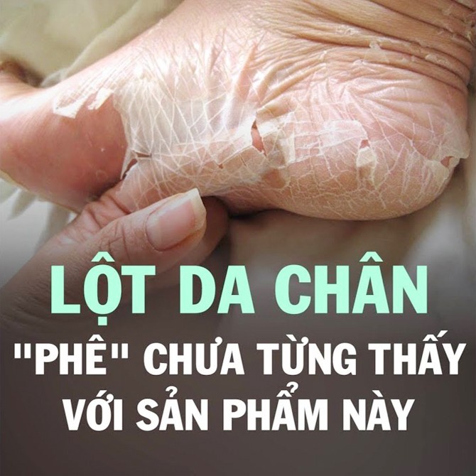 [HCM]Feelfoot Ủ Lột Da Chân Trắng Da Hết Chai Sần