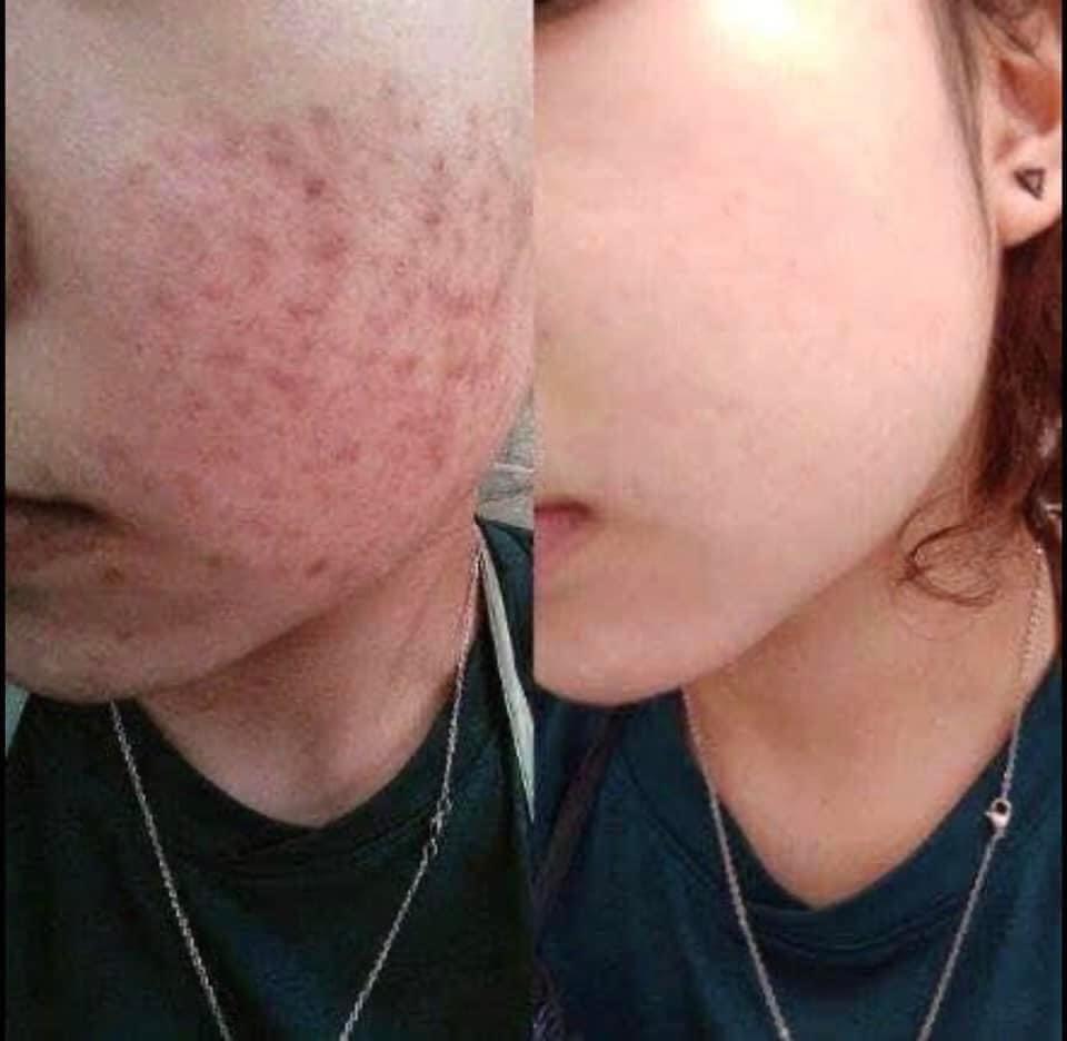 Cao lá nam diếp cá đen đặc GÔM NHÂN MỤN SAU 1 NGÀY SỬ DỤNG SẠCH MỤN THÂM NÁM DƯỠNG TÁI TẠO TRẮNG SÁNG NHANH CHÓNG