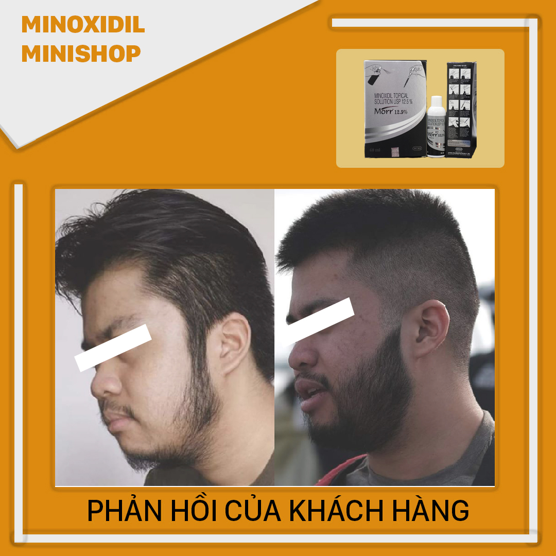 Minoxidil mọc râu tóc morr 12.5% lỏng