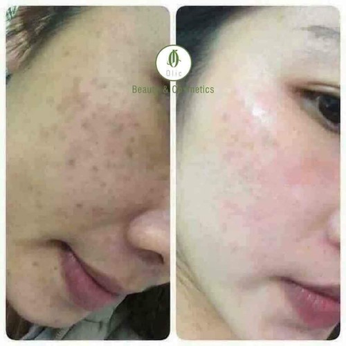 ( Hỗ Trợ Ship - Xả Hàng )  SERUM 7 DAY OLIC TRẮNG DA TRI THÂM TRI NÁM