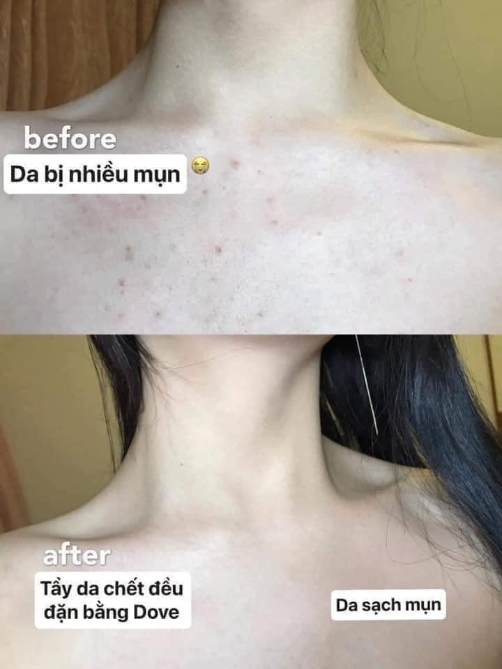 [GIẢM 5% ĐƠN 129K] TẨY TẾ BÀO CHẾT DOVE