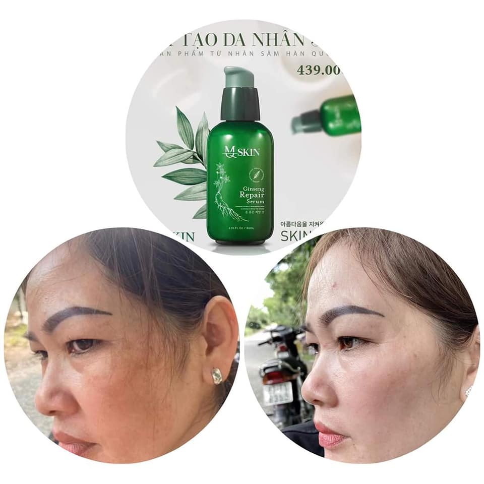SERUM TÁI TẠO DA NHÂN SÂM MQ SKIN [ xóa mụn nám tàn nhang sẹo rổ ] (80ml)