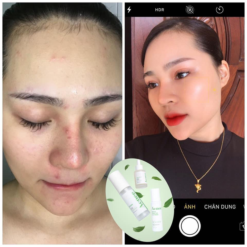 Tinh chất chấm mụn Laco Acnee - Serum Tràm trà