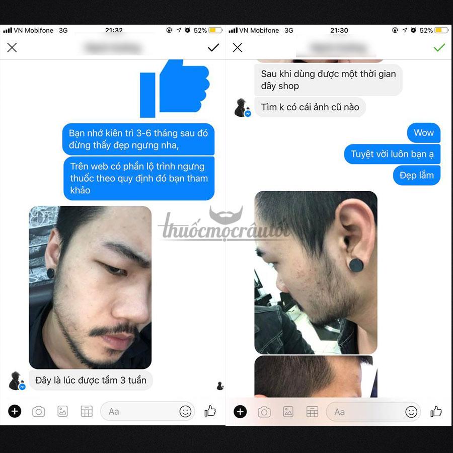 [HCM]Minoxidil 5% mọc Râu Tóc Mỹ hãng Kirkland tặng bột LCLT