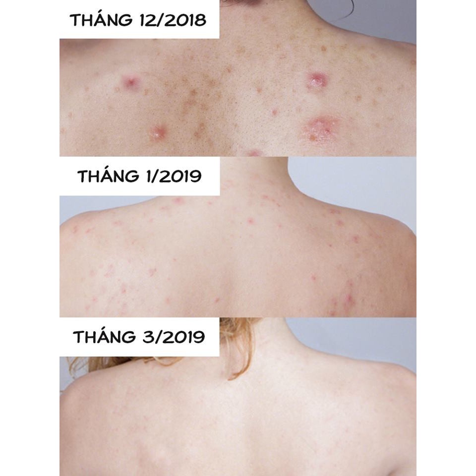 Xà phòng giảm mụn lưng For back của Nhật