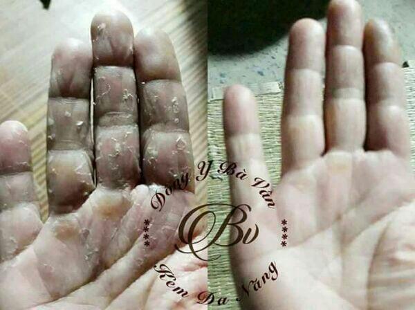 Đông Y Đa Năng Bà Vân Các Bệnh Ngoài Da