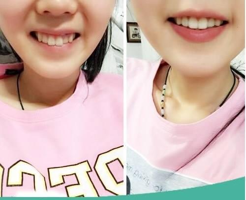 [HCM]DỤNG CỤ NIỀNG RĂNG | Dùng cho người lớn ( A1 + A2 +A3)