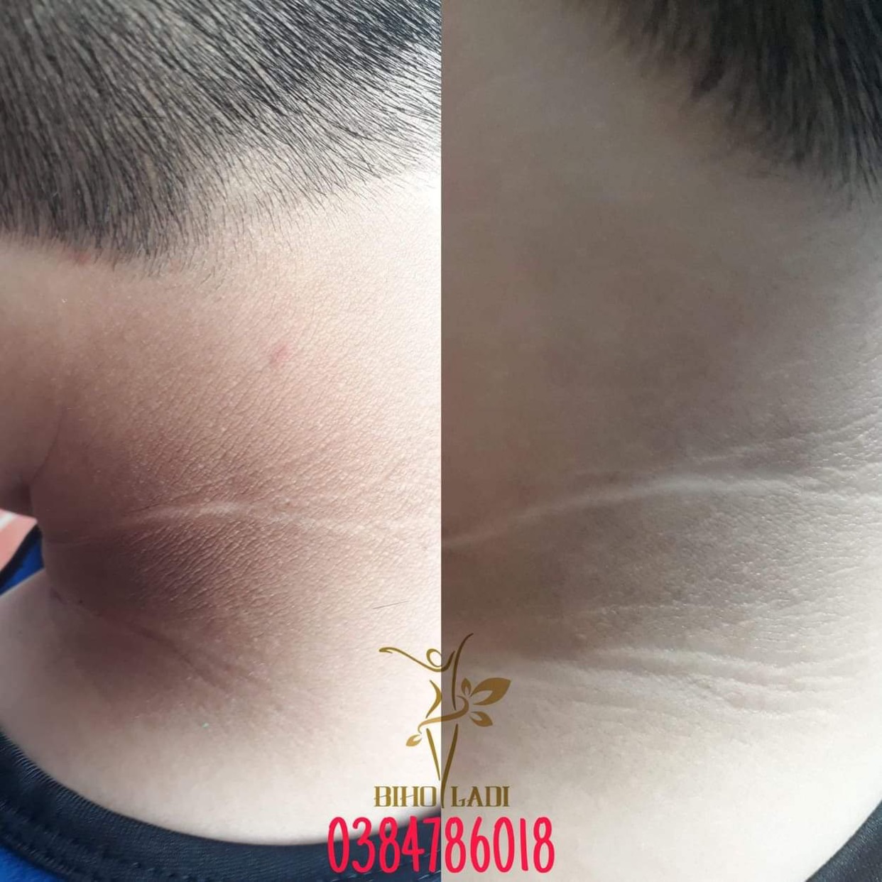 Kem Siêu Dưỡng Thâm 5S Biho Ladi