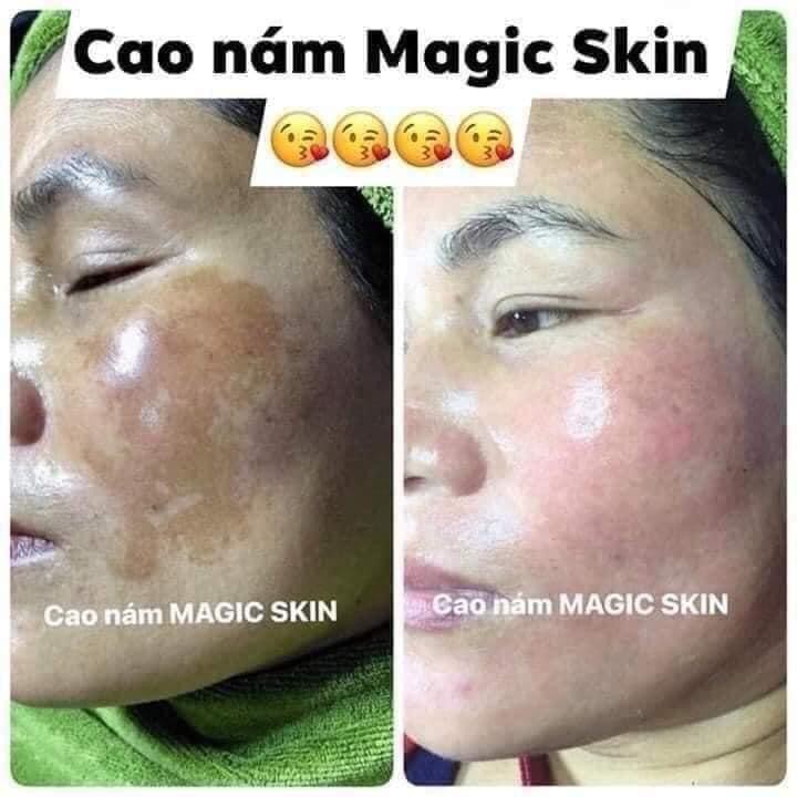 kem NÁM CỐT THÔNG ĐỎ MAGIC SKIN (HỘP TO 40g)